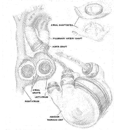 ABIOCOR HEART